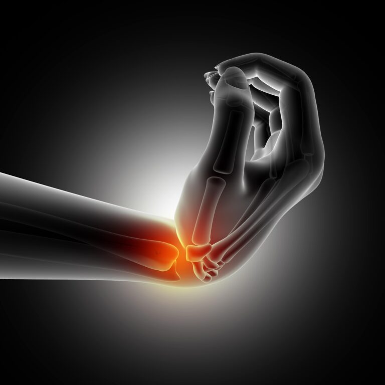 رماتیسم مفصلی چیست – التهاب مفاصل و علائم آرتریت روماتوئید